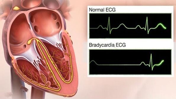 bradycardia magas vérnyomásban