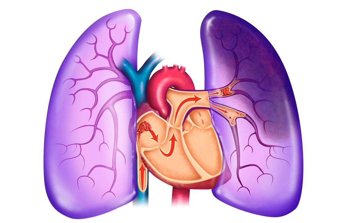 pulmonális hipertónia